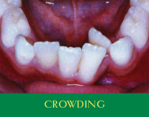 crowding-sq