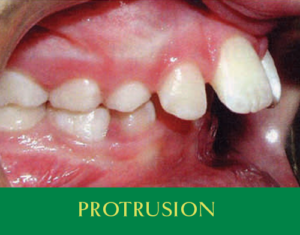 protrusion-sq