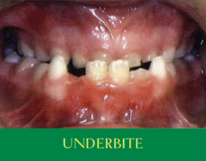 underbite-sq